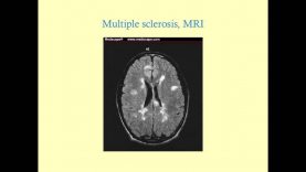 Review of Multiple Sclerosis